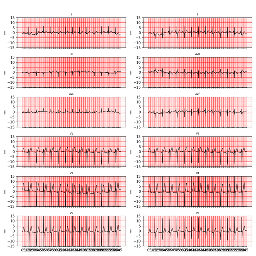 ecg_2280.png